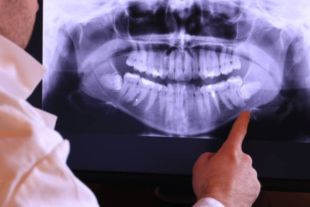 Best Emergency Wisdom Teeth Removal in Woodville, TX